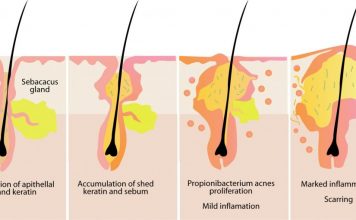 Skin Care Tips – How to Prevent Zits (Pimples) and Acnes