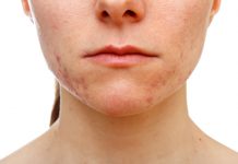 Proper Approaches On How To Prevent Cystic Acne