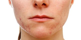 Proper Approaches On How To Prevent Cystic Acne
