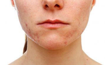 Proper Approaches On How To Prevent Cystic Acne