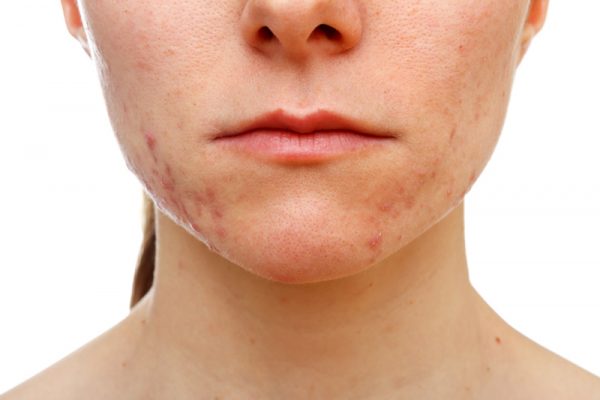 how-to-prevent-cystic-acne2