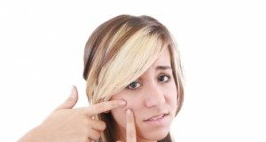 Natural Home Remedies for Acne