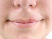 Home-Remedies-For-Cold-Sore