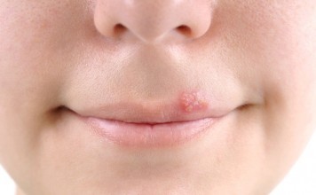 5 Things Effective for Home Remedies For Cold Sores home remedies for cold sores