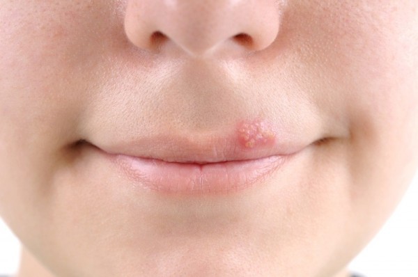 home remedies for cold sores