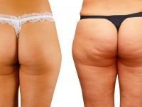 truth about cellulite review