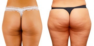 Truth About Cellulite Review – The Accurate And Unbiased Version truth about cellulite review