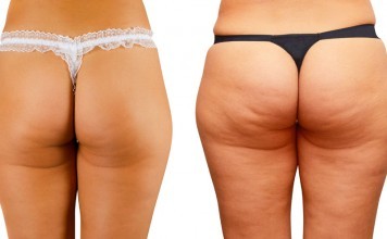 Truth About Cellulite Review – The Accurate And Unbiased Version truth about cellulite review