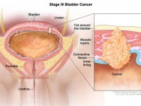 Symptoms Of Bladder Cancer
