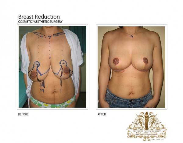 breast reduction before and after