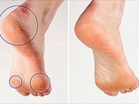 callus remover before and after