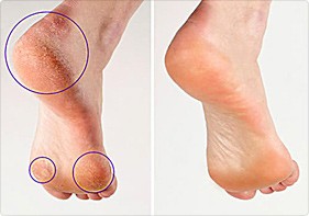 callus remover before and after