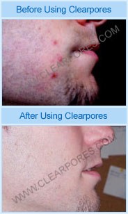 clearpores before and after