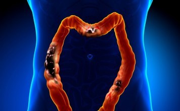 Signs Of Colon Cancer In Women And Early Prevention signs of colon cancer in women