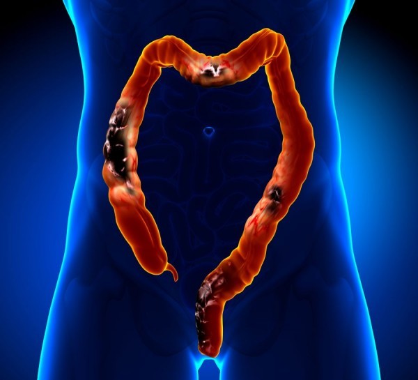 signs of colon cancer in women
