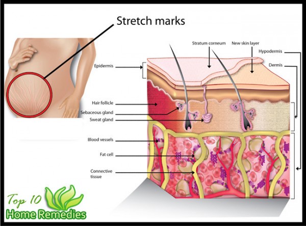 How to Get Rid of Stretch Marks Fast