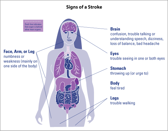 symptoms of a stroke in women