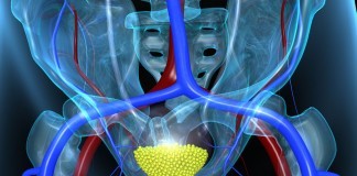 Symptoms of Bladder Cancer in Women That Should Not Be Overlooked symptoms of bladder cancer in women