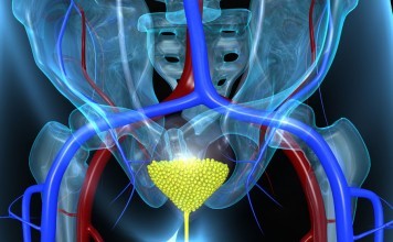 Symptoms of Bladder Cancer in Women That Should Not Be Overlooked symptoms of bladder cancer in women