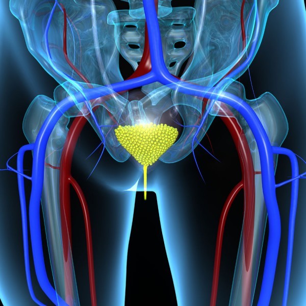 symptoms of bladder cancer in women