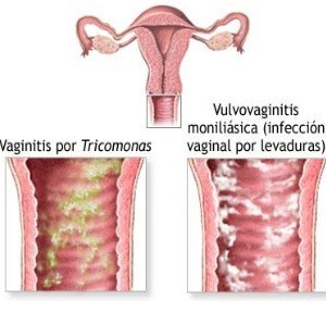 vaginal infection