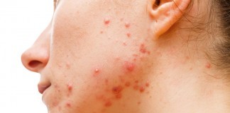 What is Cystic Acne? – The Effects Of Cystic Acne what is cystic acne