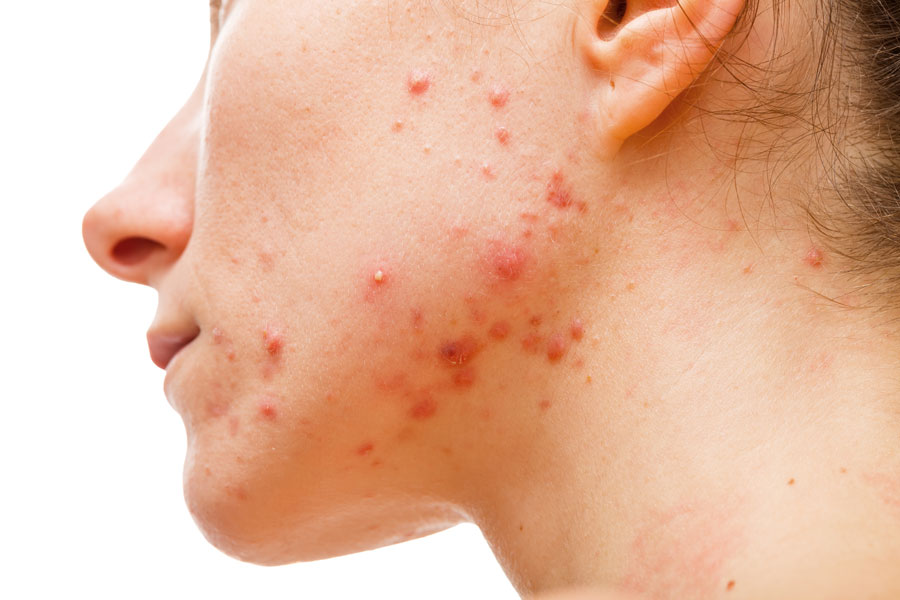 what is cystic acne