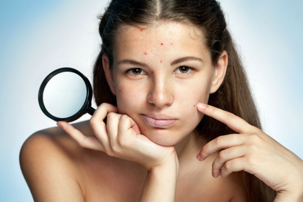 best ways to remove blackheads