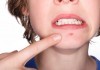 how to get rid of redness from acne
