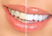 How To Whiten Teeth Fast? Everybody Wants To Know how to whiten teeth fast