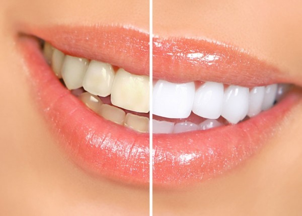 how to whiten teeth fast