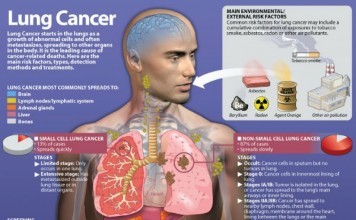 Early Detection And Signs Of Lung Cancer In Women signs of lung cancer in women