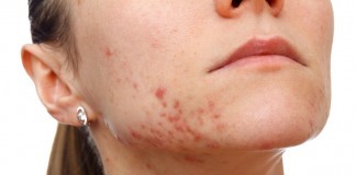 How To Get Rid Of Cystic Acne On Chin? cystic acne on chin