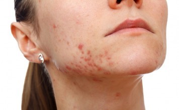 How To Get Rid Of Cystic Acne On Chin? cystic acne on chin