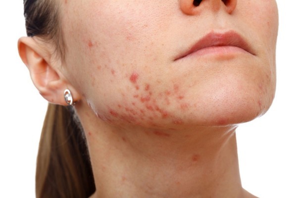 cystic acne on chin