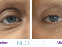 neocutis lumiere eye cream before and after