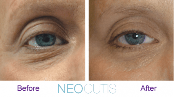 neocutis lumiere eye cream before and after