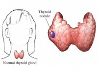 symptoms of thyroid nodules