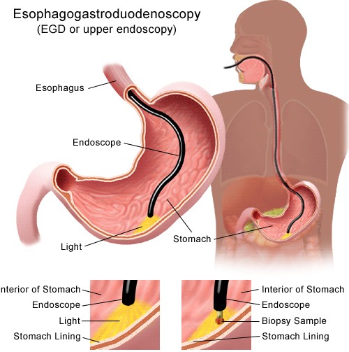 Irritable bowel syndrome