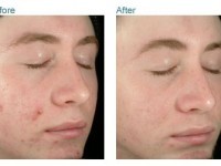 obagi clenziderm before and after