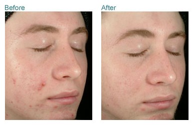 obagi clenziderm before and after