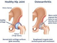 osteoarthritis hip