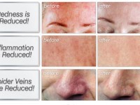 skinception rosacea before and after