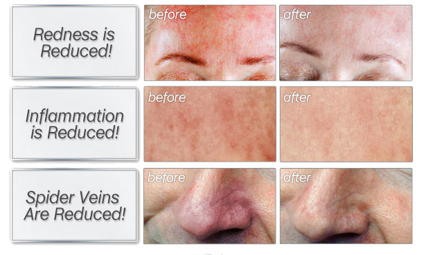 skinception rosacea before and after