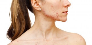 How to Get Rid of Blackheads Overnight? how to get rid of blackheads overnight